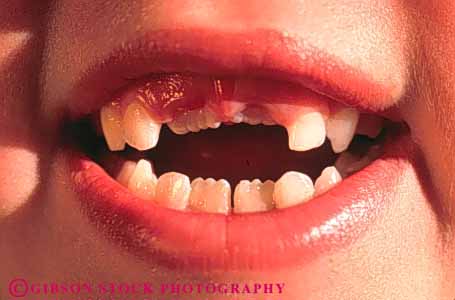 Stock Photo #3341: keywords -  children girl horz lips missing model mouth released smile teeth