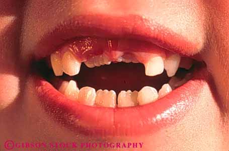 Stock Photo #3341: keywords - children girl horz lips missing model mouth released smile teeth
